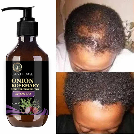 Rosemary Fast Hair Growth Shampoo Anti Hair Loss Products Repair Scalp Follicles Onion Hair Regrowth Shampoo For Women For Men